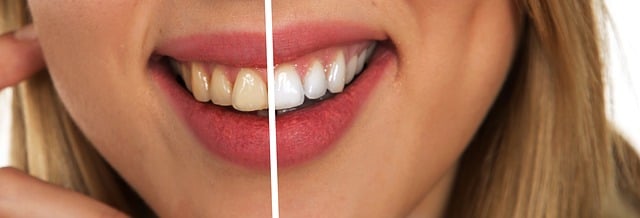 výsledek bělení zubů